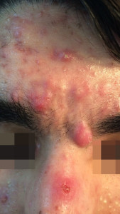London-Acne-Treatment-002-before1-1