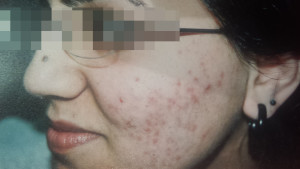 London-Acne-Treatment-003-before-1