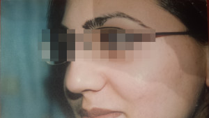 London-Acne-Treatment-003-before-after-1
