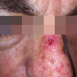 London-Basal-Cell-Carcinoma-001-before-1