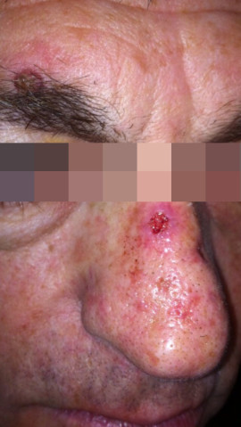 London-Basal-Cell-Carcinoma-001-before-1 London-Basal-Cell-Carcinoma-001-before-1