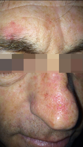 London-Basal-Cell-Carcinoma-001-before-after-1 London-Basal-Cell-Carcinoma-001-before-after-1