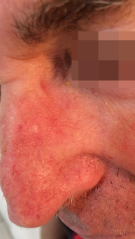 London-Basal-Cell-Carcinoma-002-before-after-1 London-Basal-Cell-Carcinoma-002-before-after-1