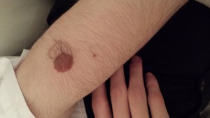 London-Birthmark-Removal-ID77019-Before-20160126_204843