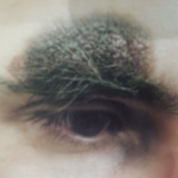London-Birthmark-removal-001-before-2