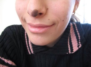 Pigmented Birthmark