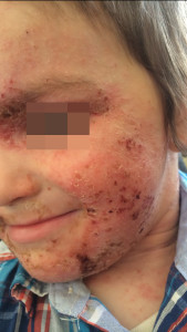 London-Dermatitis-treatment-004-before-1