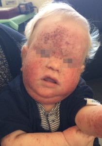 London-Dermatitis-treatment-005-before
