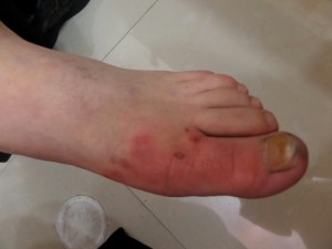 London-Eczema-treatment-001-before