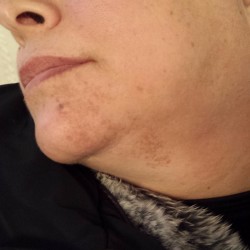London-Hormonal-Pigmentation-ID77004-Before-20160126_155309