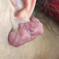 London-Keloid-removal-002-before