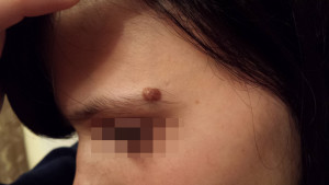 London-Moles-Removal-ID77002-Before-20160128c1