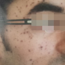 London-Moles-removal-011-before-2