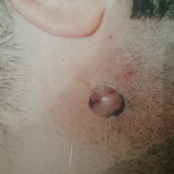 London-Nevus-removal-011-before-1