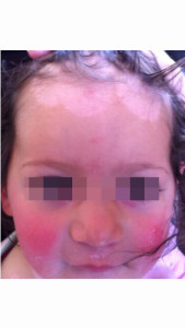London-Psoriasis-treatment-011-before-after-2