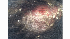 London-Seborrheic-treatment-001-before-2