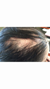 London-Seborrheic-treatment-001-before-after-1