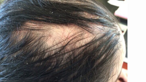London-Seborrheic-treatment-001-before-after-2