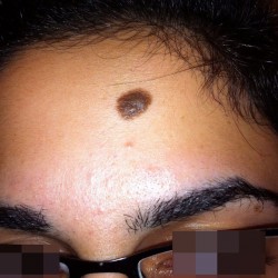 London-Skin-Growth-treatment-002-before-1