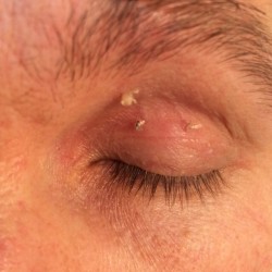 London-Skin-Tag-removal-001-before