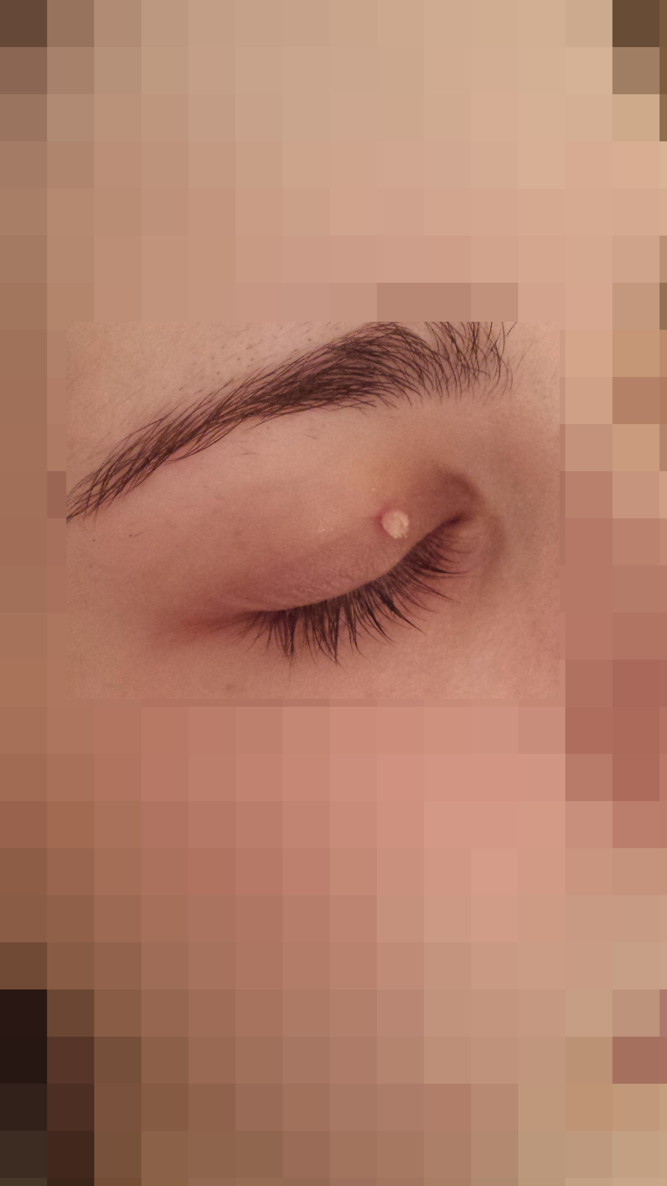 London-Skin-Tags-removal-ID77001-Before-201601171
