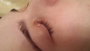 London-Skin-Tags-removal-ID77001-Before-20160117a