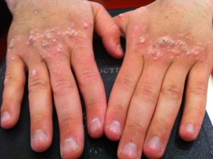 London-Warts-treatment-001-before