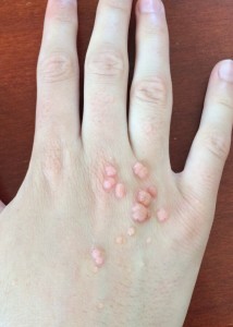 London-Warts-treatment-005-before