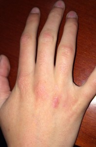 London-Warts-treatment-005-before-after
