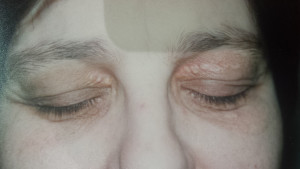 London-Xanthelasma-treatment-003-before-1