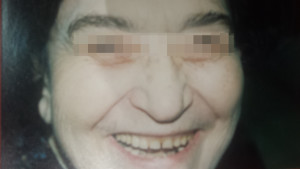 London-Xanthelasma-treatment-003-before-after-1