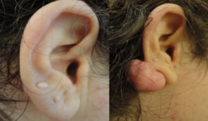 Keloid Removal