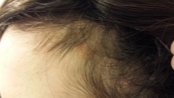 Hair Lose treatment by HP Dermatology Centre