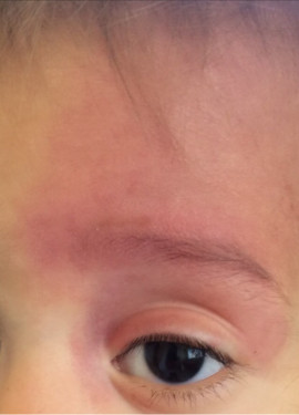 London-Hemangioma-Treatment-001-before