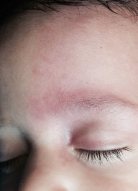 London-Hemangioma-Treatment-001-before-after