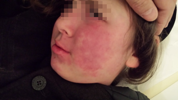 London-Hemangioma-Treatment-ID77007-before4