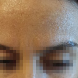 London-Milia-Removal-ID770__-Before_20160329_175822