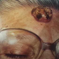 London-Squamous-Cell-Carcinoma-removal-001-before_20151201_183451 (1)